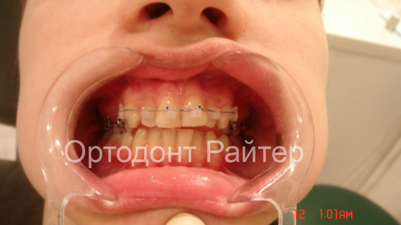 расширитель губ в ортодонтии