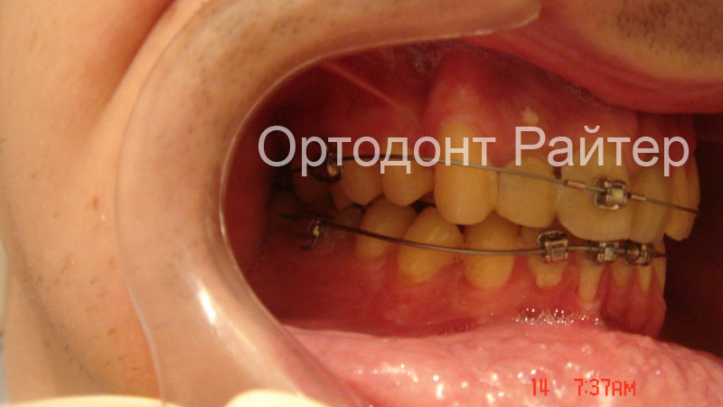 наружные ортодонтические дуги