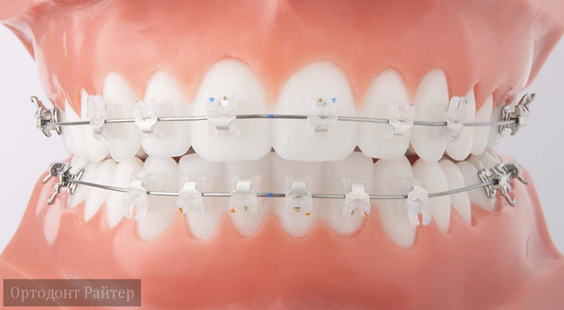 как быстро исправить зубы