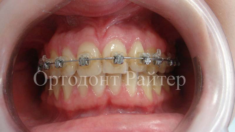 фото наружной ортодонтии