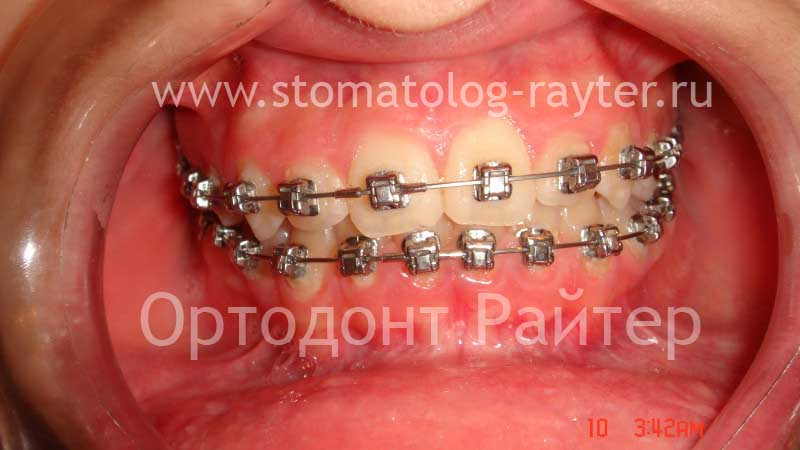 стоматология маленькой ортодонтией