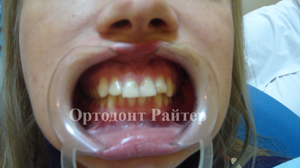 фото ортодонтии до лечения