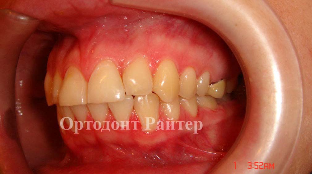фото после ортодонтии