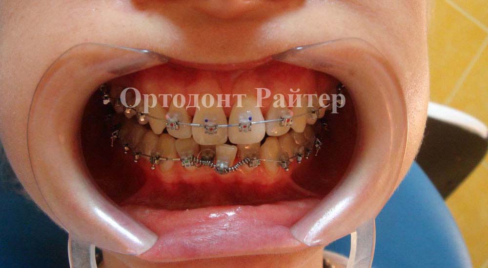 фото по детской ортодонтии