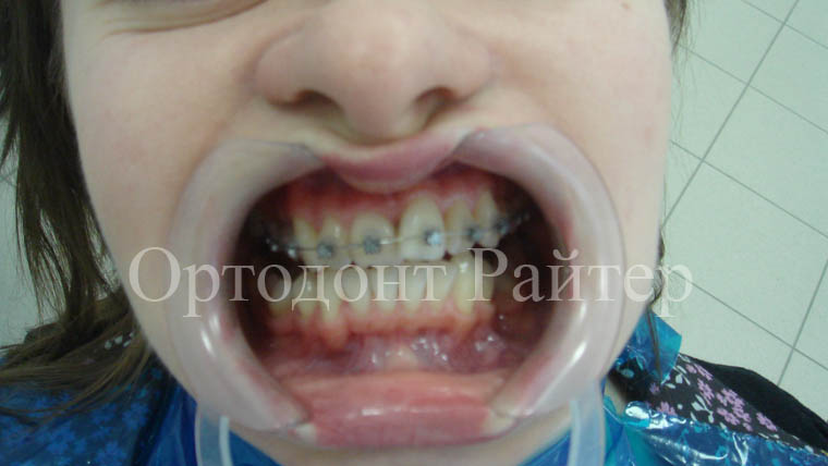 ортодонтическая система