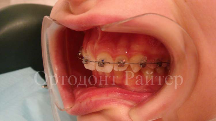 ортодонтический пациент