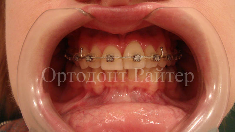 результат в ортодонтии